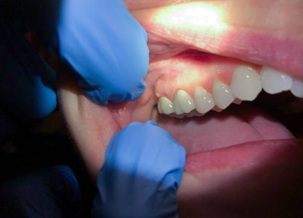 Best Emergency Dental Extractions in Edwardsville, PA